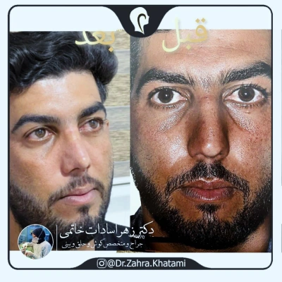 کار جراحی زیبایی بینی دکتر زهرا خاتمی
