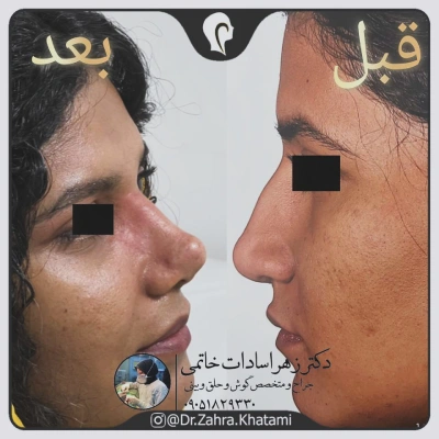 نمونه کار جراحی زیبایی بینی دکتر زهرا خاتمی