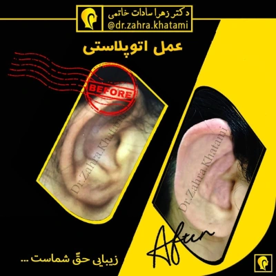 نمونه کار جراحی گوش دکتر خاتمی
