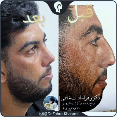 نمونه کار جراحی بینی دکتر خاتمی