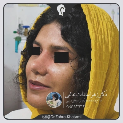 نمونه کار جراحی بینی دکتر خاتمی