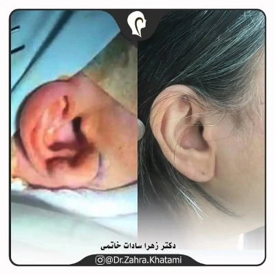 نمونه کار اتوپلاستی دکتر خاتمی