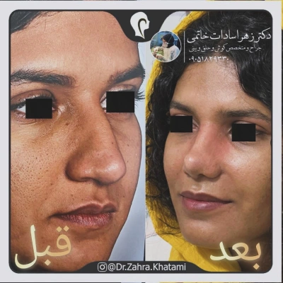 نمونه کار جراحی زیبایی بینی دکتر خاتمی