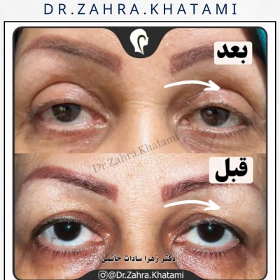 نمونه کار بلفاروپلاستی دکتر خاتمی