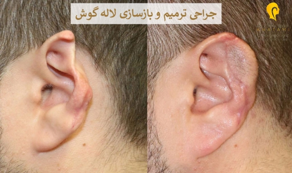 جراحی ترمیم و بازسازی لاله گوش