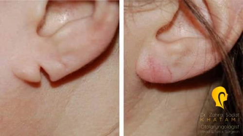 ترمیم لاله گوش