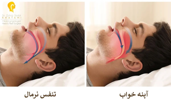 آپنه خواب چیست؟
