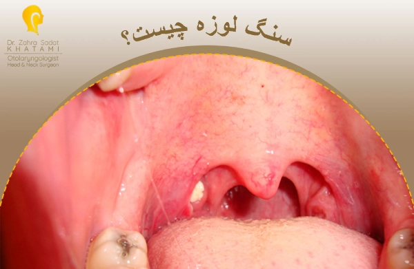 سنگ لوزه
