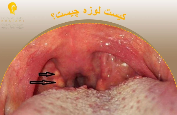کیست لوزه