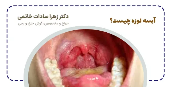 آبسه لوزه چیست