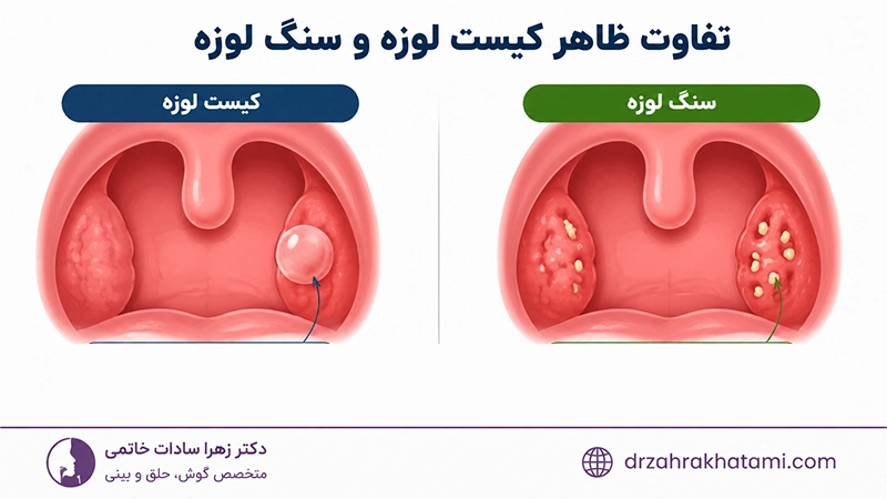 تفاوت ظاهر کیست لوزه و سنگ لوزه