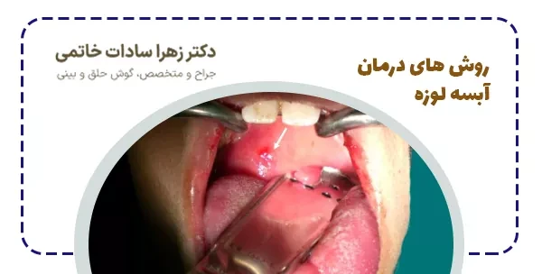آبسه لوزه