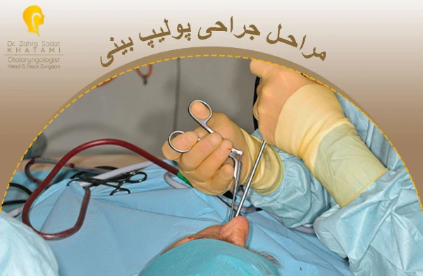 مراحل جراحی پولیپ بینی چگونه است؟