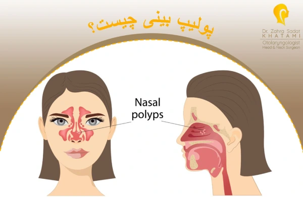 پولیپ بینی چیست؟