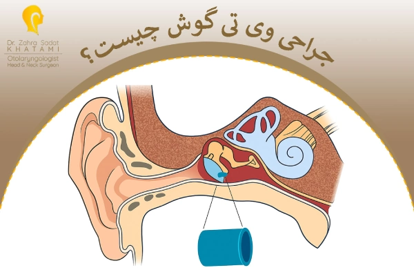 جراحی وی تی گوش چیست؟