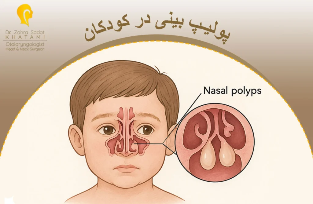 پولیپ بینی در کودکان