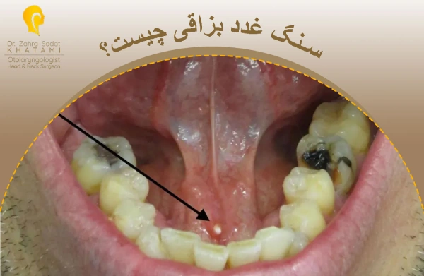 سنگ غدد بزاقی چیست؟