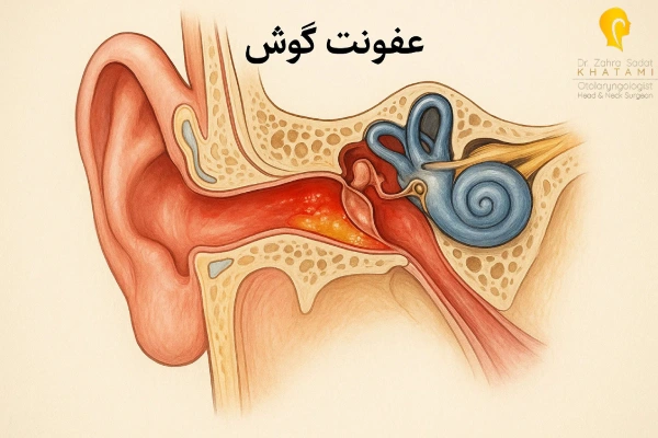 عفونت گوش