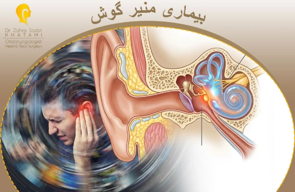 بیماری منیر گوش