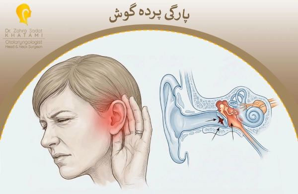 پارگی پرده گوش